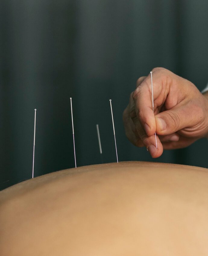 ACUPUNTURA
